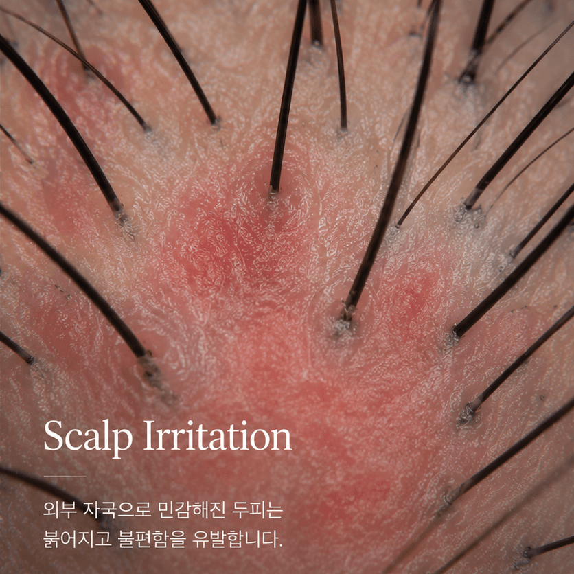 외부 자극으로 민감해진 두피